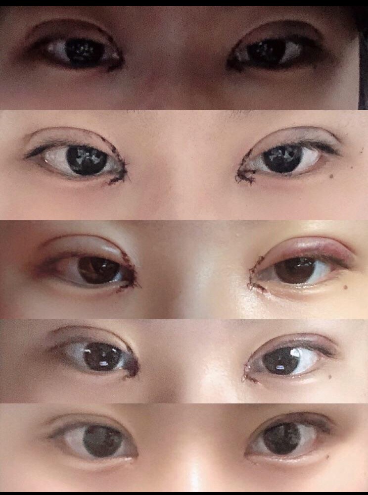 윗트임 자연유착 후기