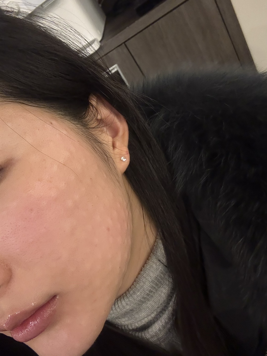 수면마취 걱정했는데 꿀잠 자고 왔어요 (엠보싱 대박)