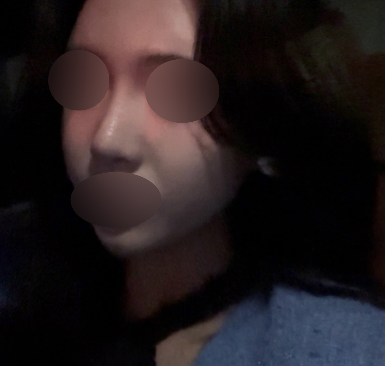 코성형 2달차, 정면 셀카가 자신있어졌어요