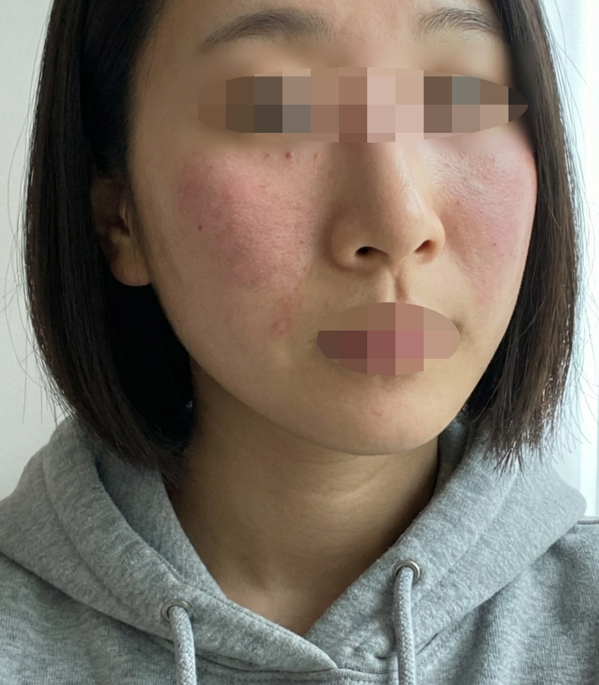 리쥬란 받았는데 꼼꼼하게 해주시고 피부 촉촉해진 것 같아요~다들 친절해서 또 오려고요!