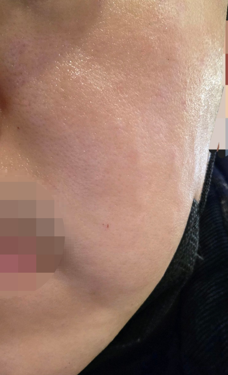 리쥬란 받았는데 수면으로 진행해서 통증도 없고 케어까지 해줘서 좋네요~