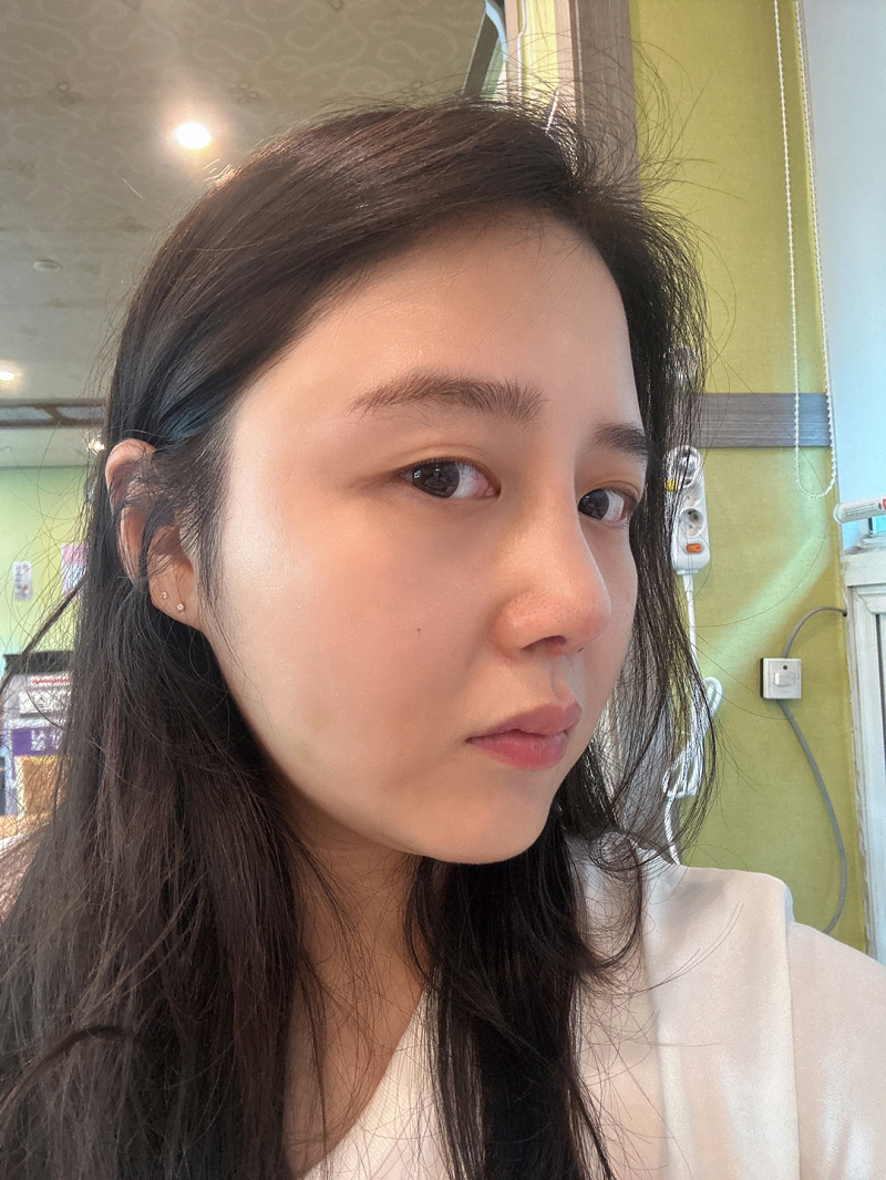 아직 붓기가 덜 빠졌지만 하루만에 쑥쑥 예쁘게 빠지고 있어요! :)