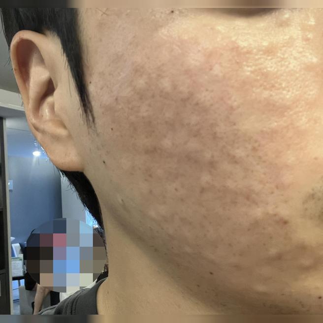 촘촘한 엠보에 친절한 응대까지, 리쥬란 만족스러웠습니다.