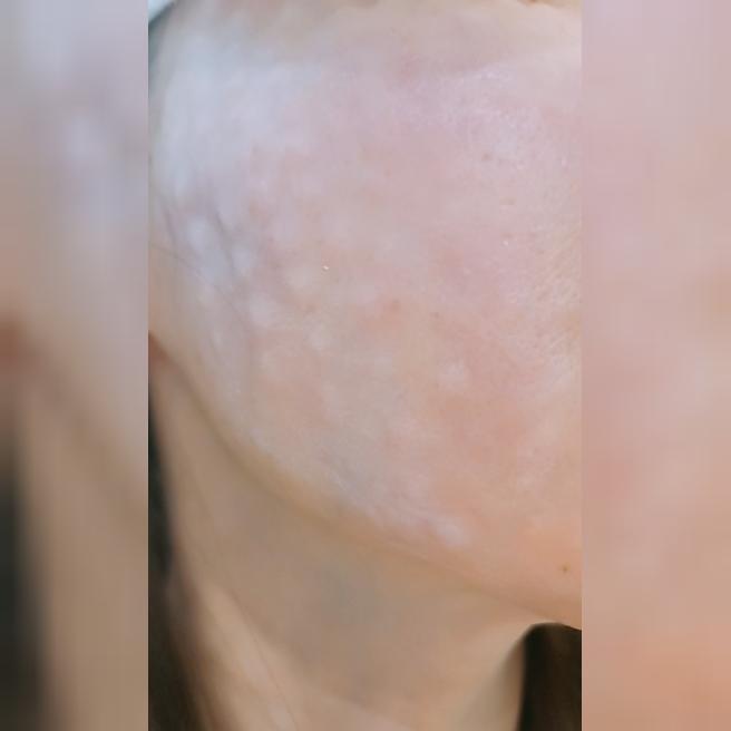 엠보 꼼꼼하고 효과 좋아서 리쥬란 주기적으로 받고 있어요~!