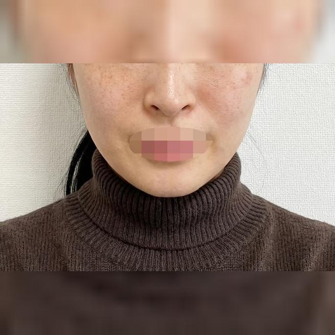 리쥬란이랑 온다리프팅 같이 받았는데 다음 달에도 오려고요 ㅎㅎ