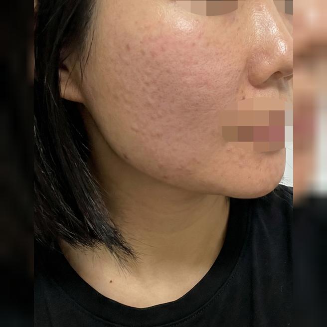 수면으로 받았는데 자고 일어나니 끝나 있어서 편하고 좋네요!ㅎㅎ