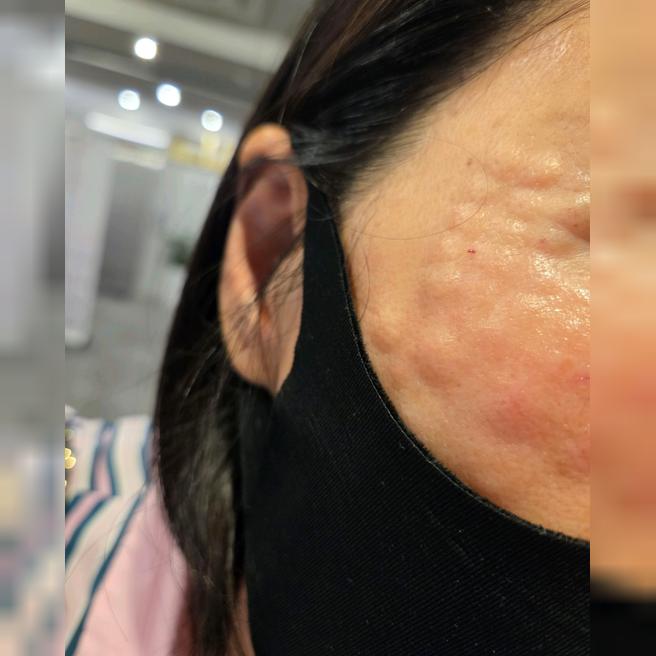 리쥬란 2번째인데 역시 만족이라 계속 다니려고요~다들 친절하고 효과도 좋아요!