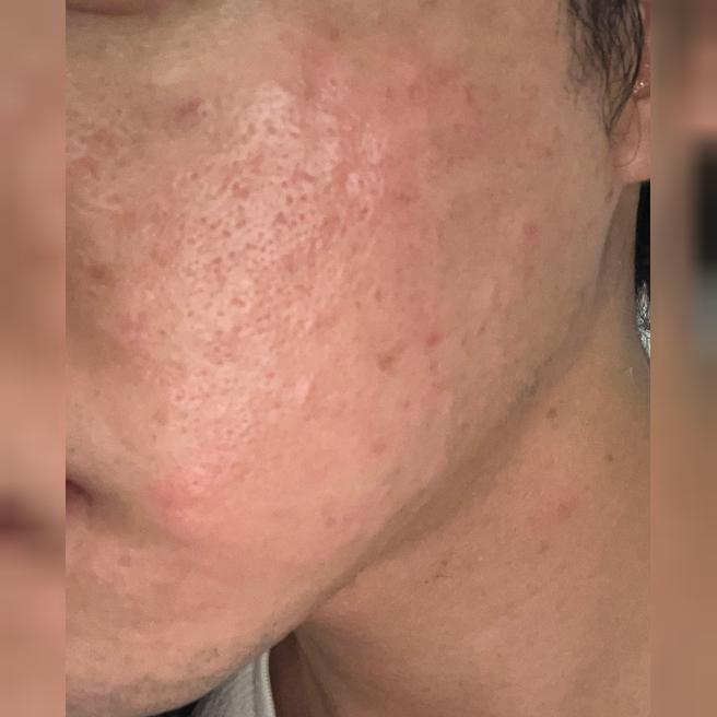 수면 리쥬란 엠보 하루 만에 가라앉고 너무 만족스러웠어요.