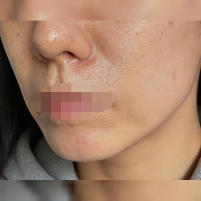 주위에서 효과 크게 봤다길래 리쥬란 기대하고 받아봤어요~
