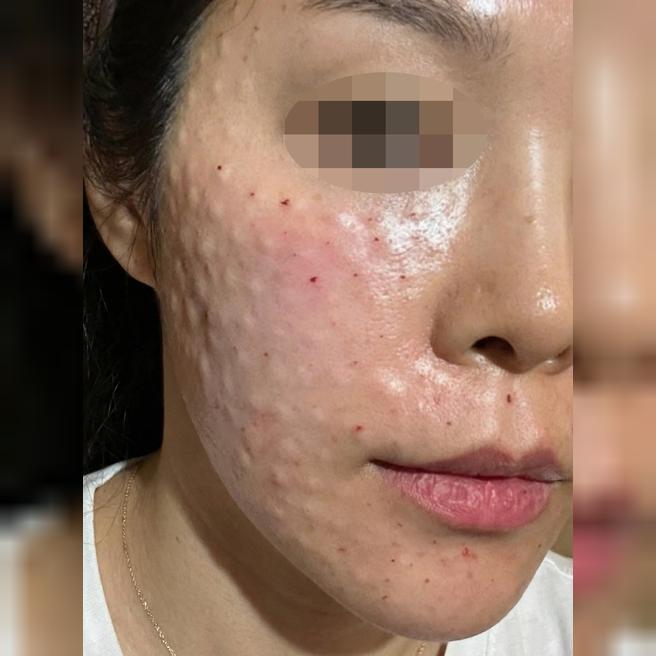 피부탄력 고민이라 리쥬베룩 받았는데 재방문 예정이에요!