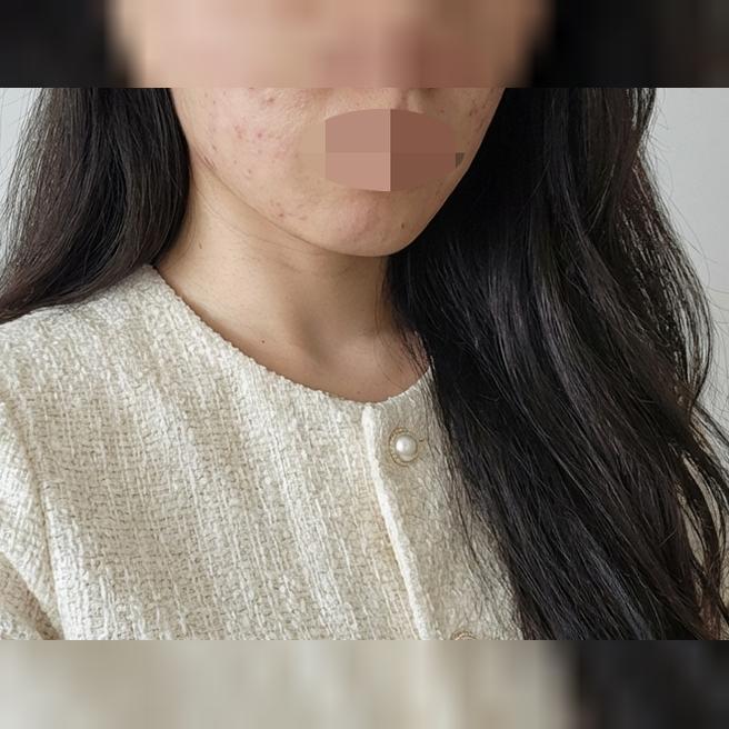이중턱 심해진 것 같아서 수면 인모드 받으러 왔습니다.