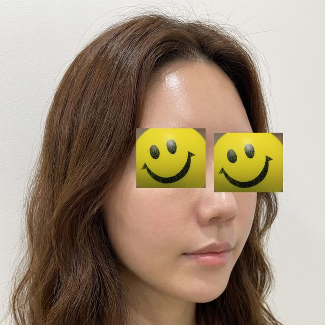 리쥬란 맞고 나서 2주 지났는데 윤기가 이 정도일 줄은 몰랐어요