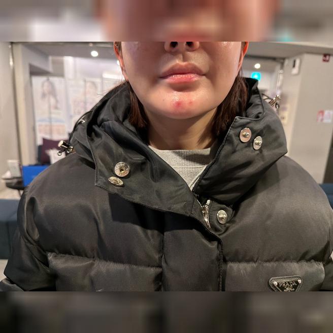 원장님부터 직원분들까지 다 친절! 볼뉴머리프팅 잘 받고 왔어요