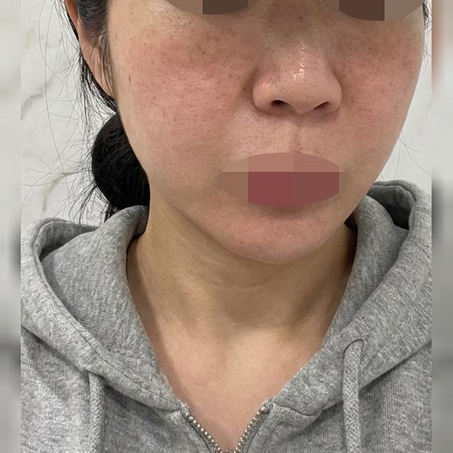 속건조 심해서 다들 추천해준 리쥬란 받았는데 엠보 촘촘해서 만족이에요 ㅎㅎ