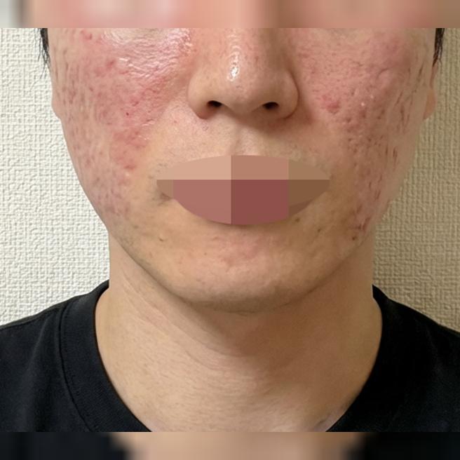 약속 많아지고, 피부 노화 체감에 리쥬란 받아봤습니다.