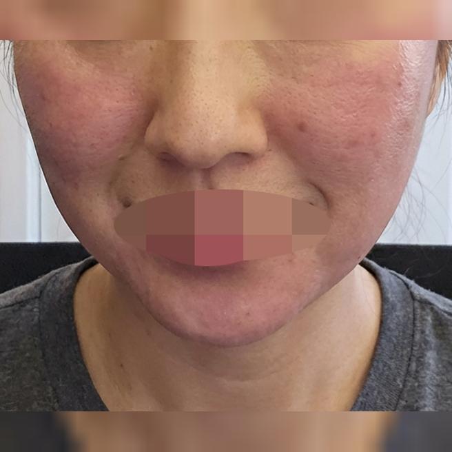 피부 거칠어진 것 같아서 엑소좀 받으러 왔어요~