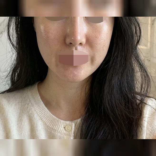 한국 실리프팅 좋다고 해서 왔는데, 하길 잘한 것 같아요~ 너무 만족합니다!