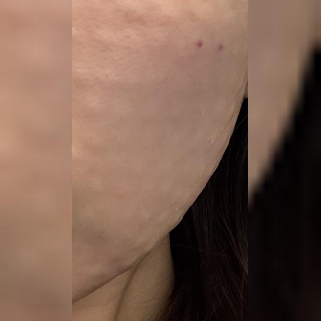 만성 건조 피부 고민으로 리쥬란 드디어 받아봤어요~!