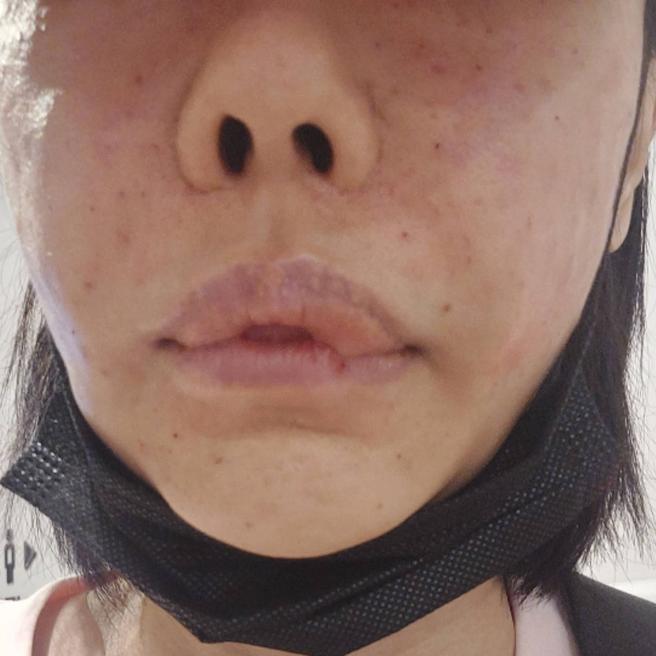 쥬베룩 시술 후 2일차 솔직 후기 ! 이 정도면 괜찮은 건가요?