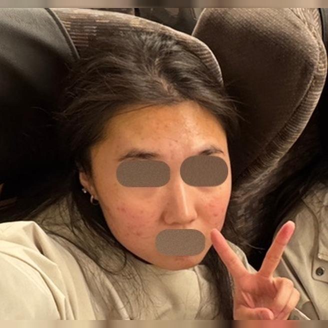 여드름 흉터·모공·이중턱 한번에 잡으러 왔어요~ 리쥬란힐러 솔직 후기