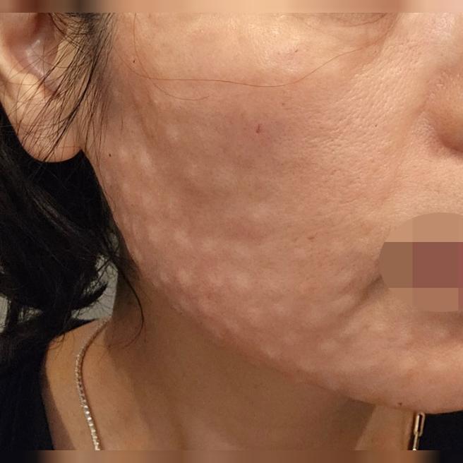 피부 늘어짐이랑 잔주름 고민으로 리쥬란 받아봤어요~