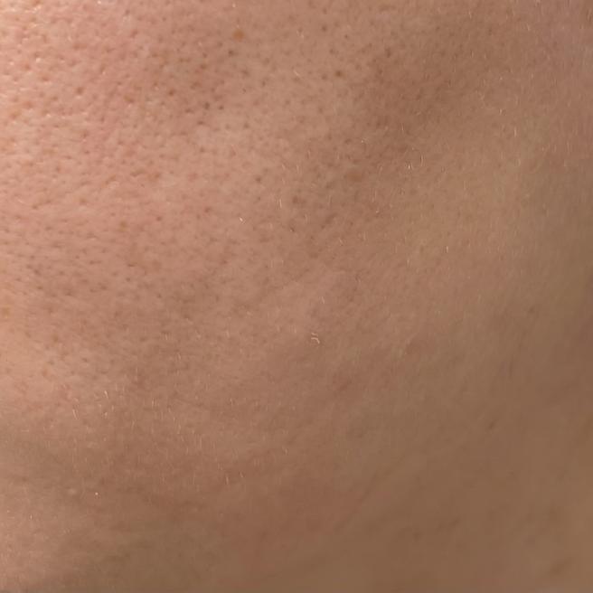 포텐자 맞은 지 3일차~!! 붓기 빠지고 나니까 피부결이 진짜 달라요