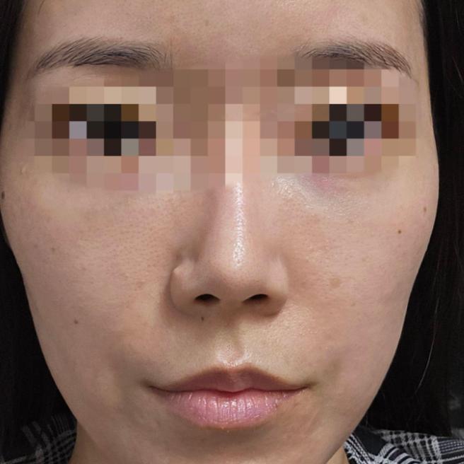 포텐자 3일차, 붉은기 가라앉고 피부결 회복 중이에요