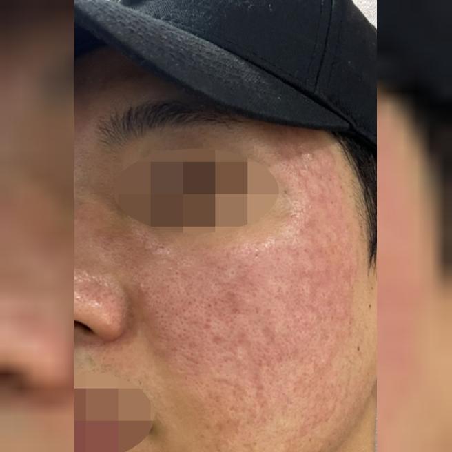 30대 되니 피부 탄력 떨어져서, 리쥬란으로 케어 시작했습니다.