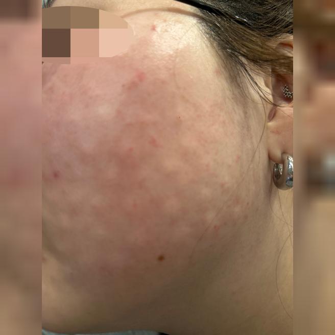 30대 중반 건조함 때문에 왔는데 원장님 시술 잘해주셔서 좋았어요~