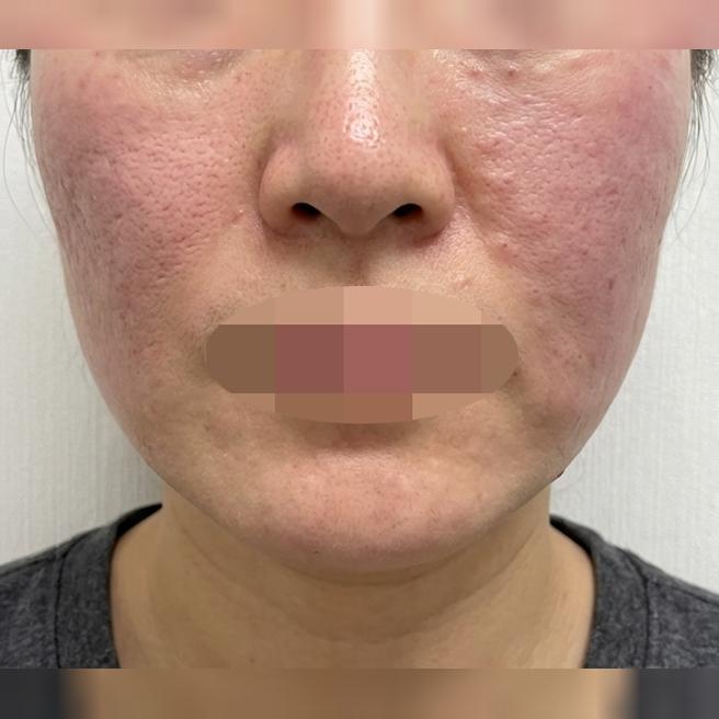 아플수록 효과 좋다는 리쥬란, 수면으로 편하게 받아봤어요