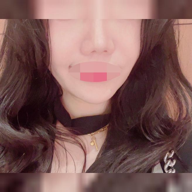 처음이라 걱정했는데 수면으로 편하게 리쥬란힐러 받았어요~