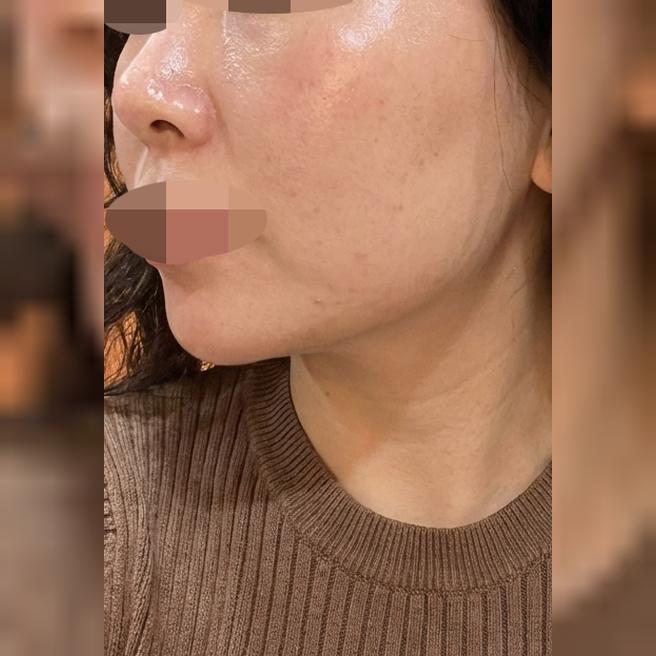 온다 리프팅 받았는데 친절하고 로테이션 빨라서 또 오려고요 ㅎㅎ