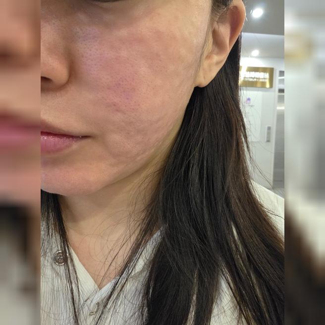 서울아이성형외과 리쥬란은 믿고 하는 시술! 1일차 솔직 후기예요