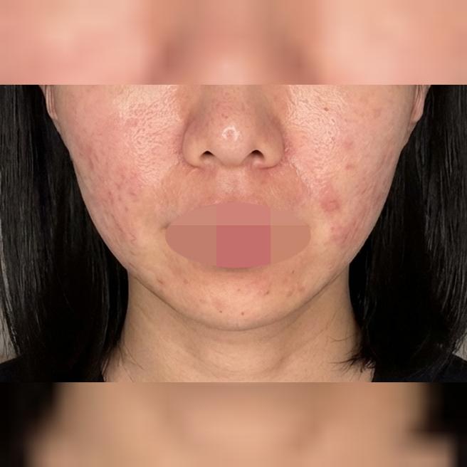 쥬베룩이랑 연어주사 같이 되는 곳 찾다가 수면으로 편하게 받았어요~