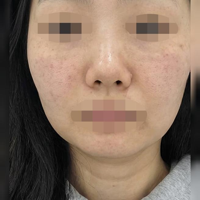건조해서 리쥬란 받았는데 대기 없고 친절해서 좋았어요!