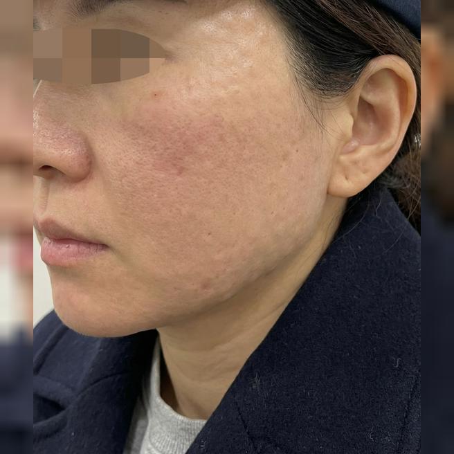 리쥬란 주기적으로 받는 이유ㅎㅎ 엠보 촘촘하고 효과 좋아서 계속 다닙니다~