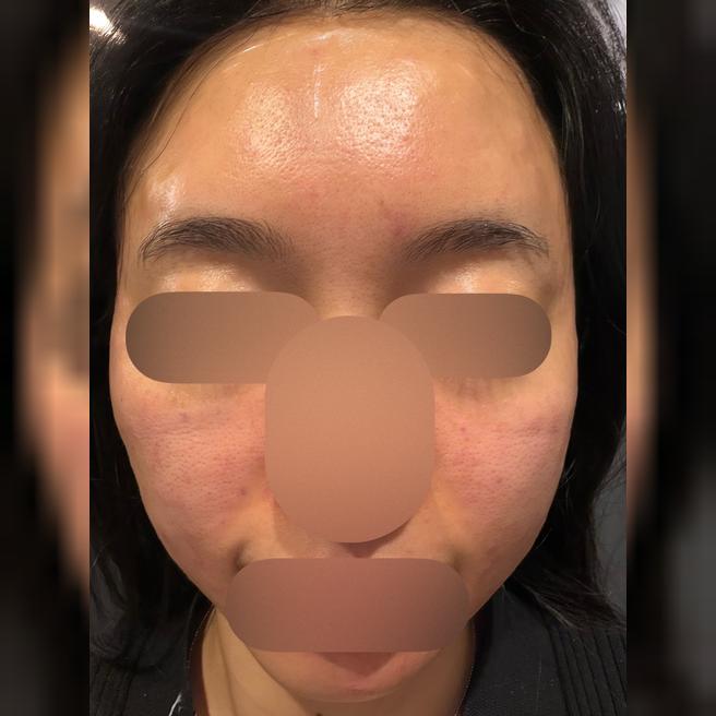 눈코입 주변 잔주름 고민으로 방문했어요ㅎㅎ 수면으로 편하게 받고 왔습니다~