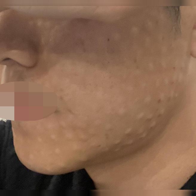 마취 크림 덕분에 통증 부담 없이, 꼼꼼한 시술까지 만족이에요.