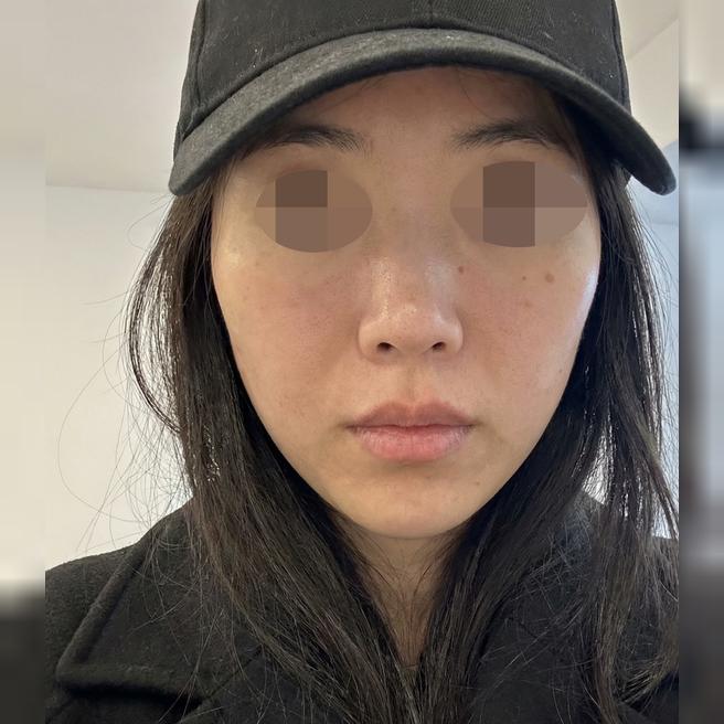 엠보 걱정했는데 진정관리 끝나니 일상생활 바로 가능해요ㅎㅎ