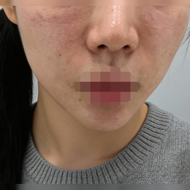 리투오 받았는데 바로 일상 복귀 가능하고 만족이에요~ 그리고 친절하고 꼼꼼해서 편하게 받았습니다!