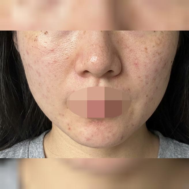 수면으로 받으니 안 아프고 편해서 선택하길 잘했어요ㅎ