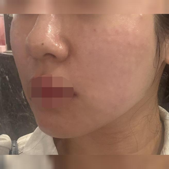 다른 곳에서 멍 많이 들었는데 여기서 리쥬란 받으니 완전 달랐어요!