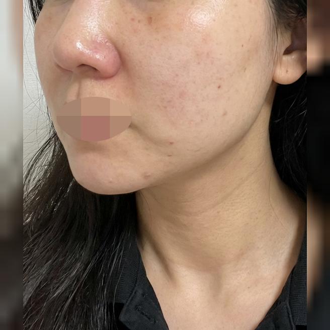 수면으로 인모드 받았는데 아프지 않게 끝나서 너무 좋았어요!!