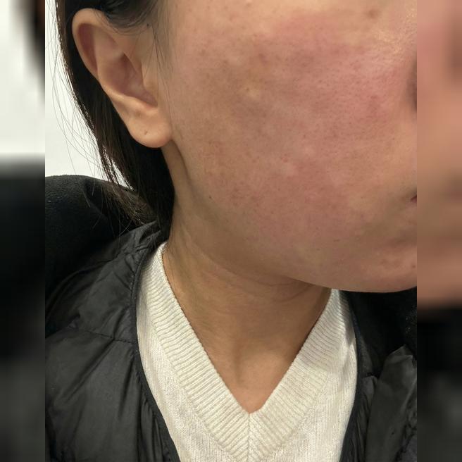 세 번째 재방문~ 멍도 별로 없고 효과 좋아서 계속 오게 돼요!