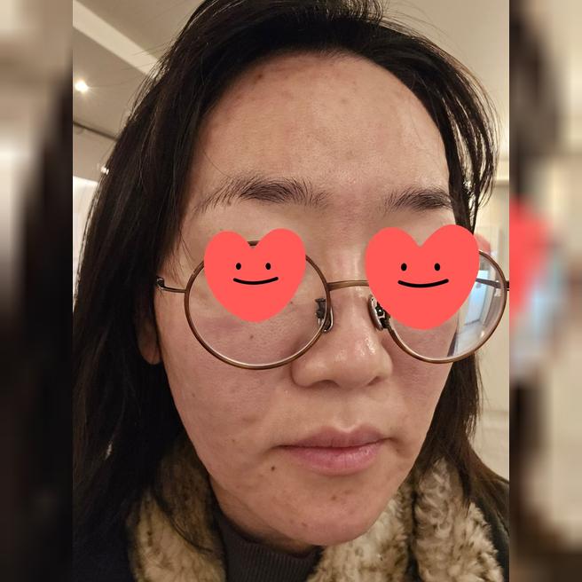푸석한 피부 살리려고 리쥬란 2회차 맞고 왔어요 (수면 시술 후기)
