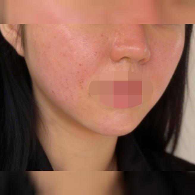 나비존, 모공, 흉터 고민으로 여기 꾸준히 관리 중입니다~