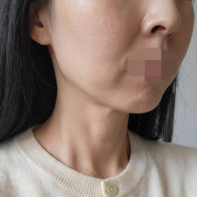 얼굴 라인 고민으로 온다리프팅 받았는데 확실히 달라진 느낌이에요~