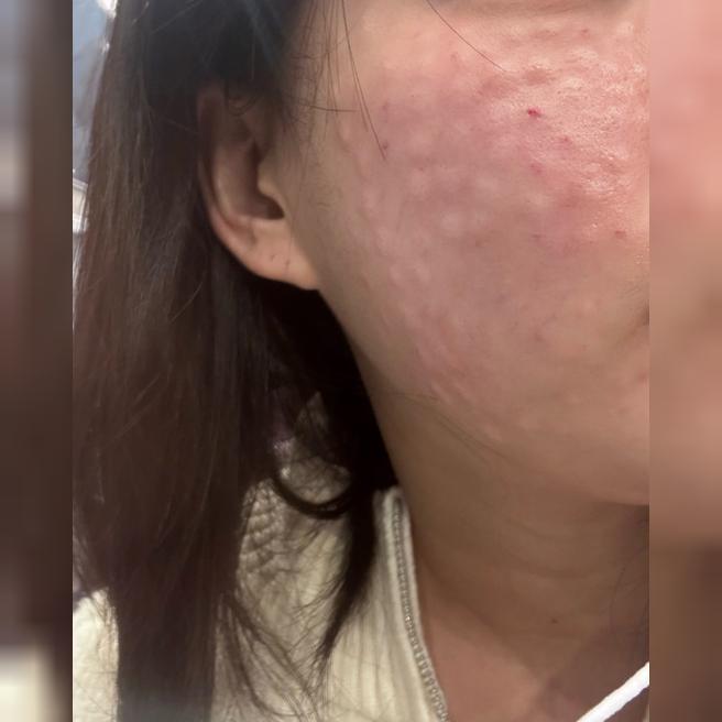 작년에 맞고 효과 좋아서 올해도 쥬베룩! 2일차 지금