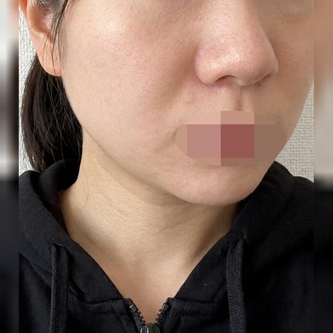 피부 탄력 위해 시작한 쥬베룩, 만족스럽게 받고 왔어요