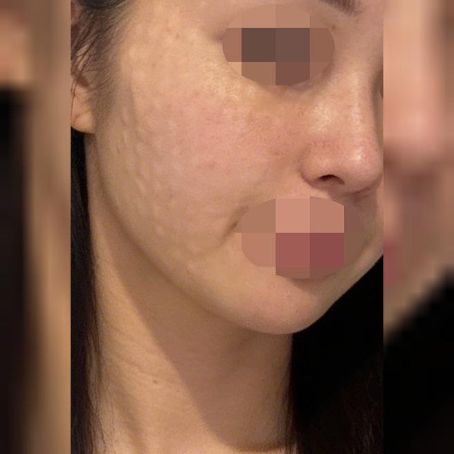 수면 리쥬란 받았는데 너무 만족이에요 ㅎㅎ